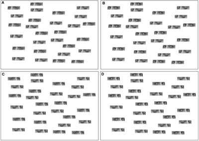 Direct Gaze Partially Overcomes Hemispatial Neglect and Captures Spatial Attention